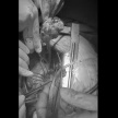 В Набережных Челнах врачи БСПМ удалили из сердца пожилой пациентки гигантскую опухоль